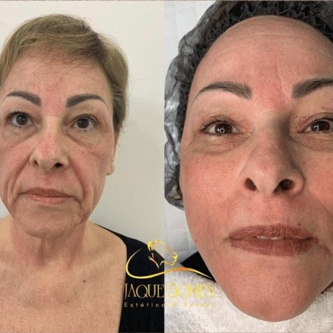 Diamond peeling skin treatment